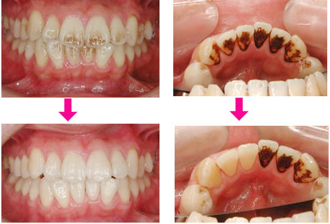 値段 歯石 取り 歯とお口の健康を守る歯石除去の費用、実は意外と安かった！